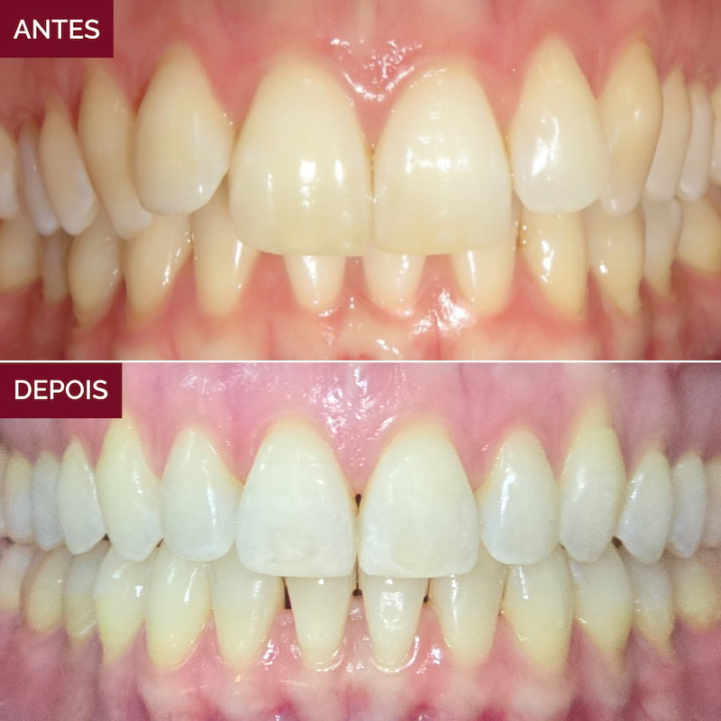 resultado-alinhadores-invisíveis1