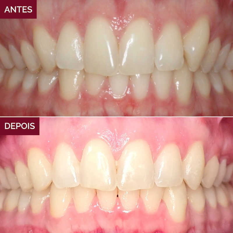 resultado-alinhadores-invisíveis2