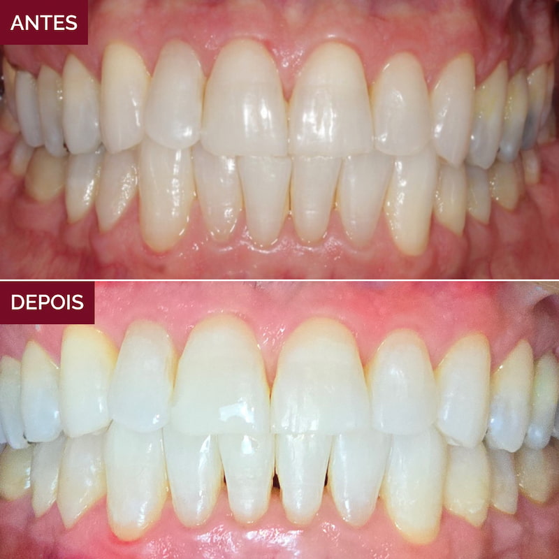 resultado-alinhadores-invisíveis3