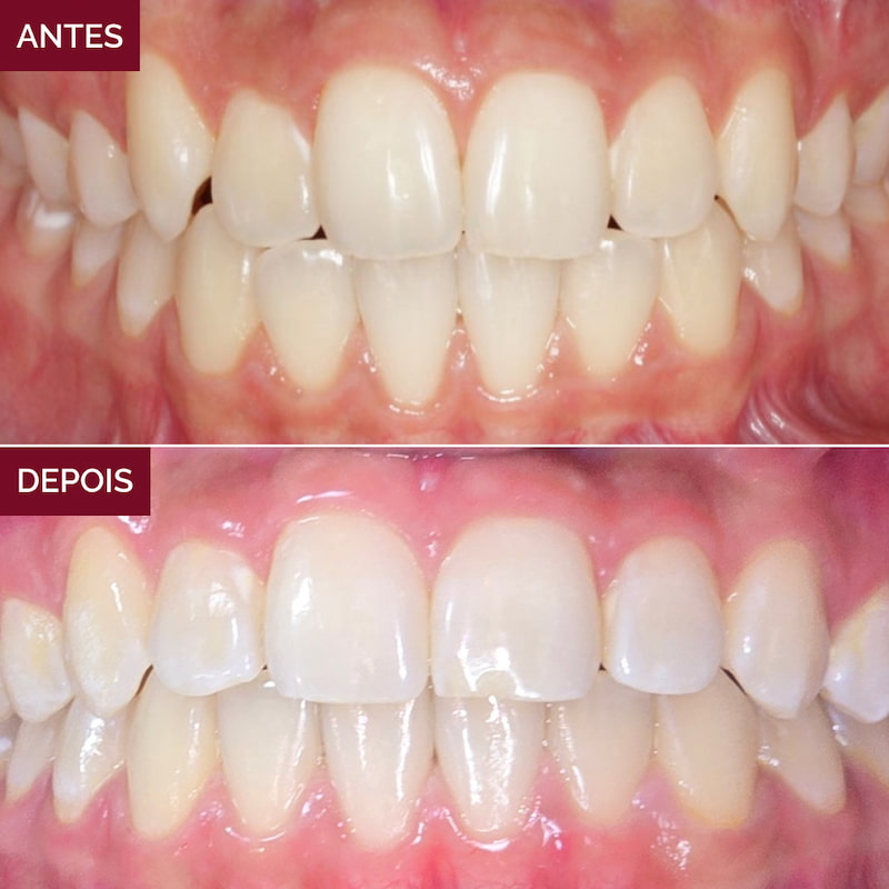 resultado-alinhadores-invisíveis4