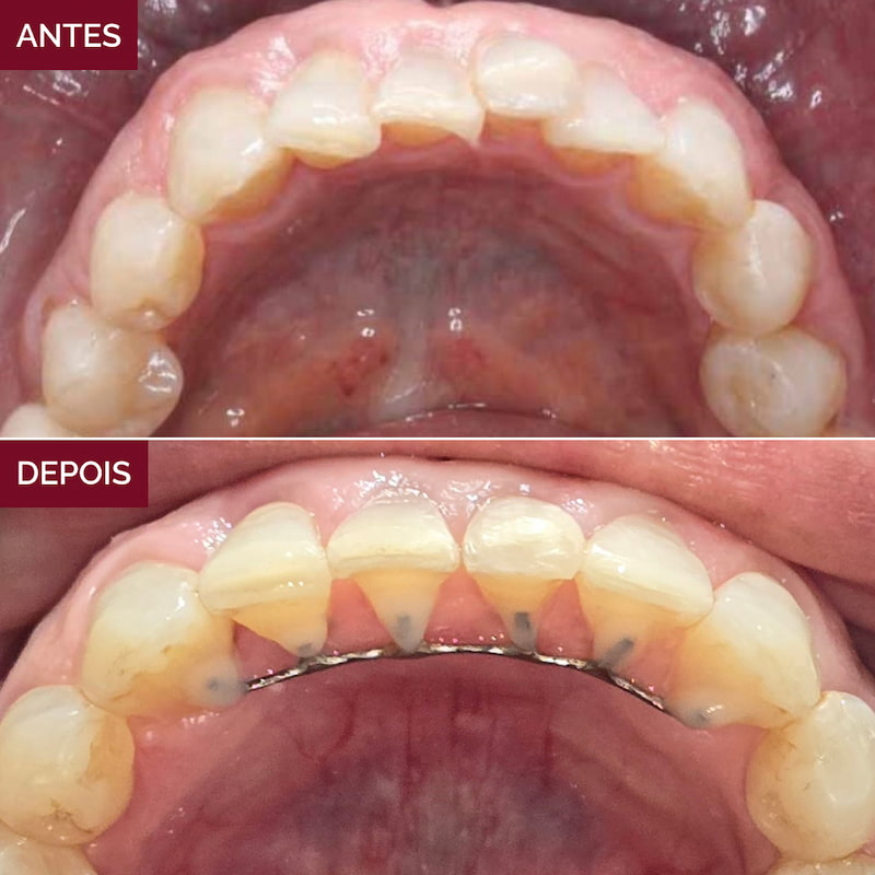 resultado-alinhadores-invisíveis5